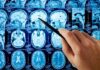 A hand pointing at MRI brain scans displayed on a screen