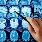 COVID Vaccine Sparks Brain Vessel Mystery A hand pointing at MRI brain scans displayed on a screen