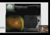 Bionic Implant Lets The Blind Read Again Macular Milestones 2026